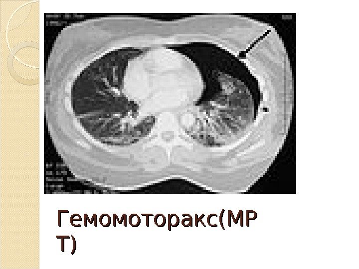 Гемомоторакс(МР Т)Т)  
