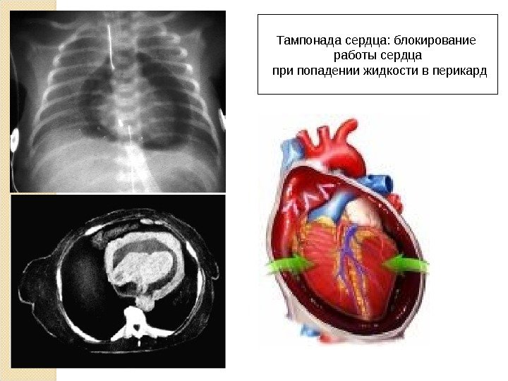 Тампонада сердца: блокирование работы сердца  при попадении жидкости в перикард 