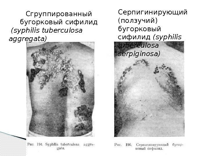 Сгруппированный бугорковый сифилид (syphilis tuberculosa aggregata) Серпигинирующий (ползучий) бугорковый сифилид (syphilis tuberculosa serpiginosa) 