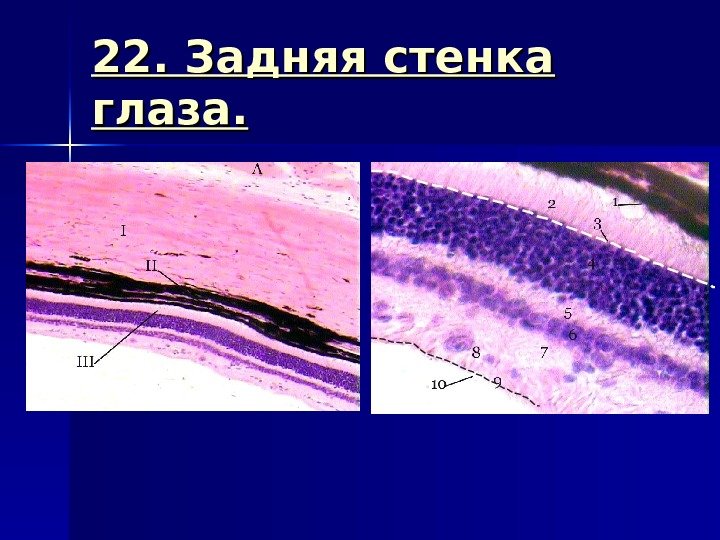 22. Задняя стенка глаза. 