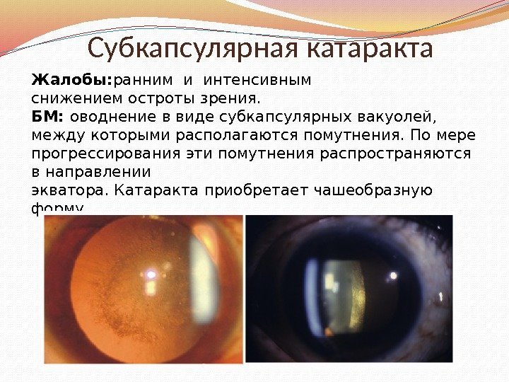Субкапсулярная катаракта Жалобы: ранним и интенсивным снижением остроты зрения.  БМ:  оводнение в