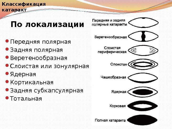 По локализации Передняя полярная Задняя полярная Веретенообразная Слоистая или зонулярная Ядерная Кортикальная Задняя субкапсулярная