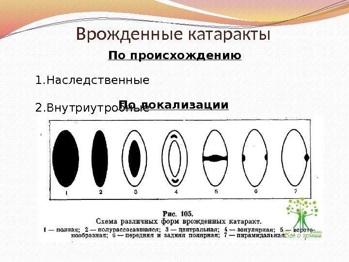 Врожденные катаракты 1. Наследственные 2. Внутриутробные По происхождению По локализации 