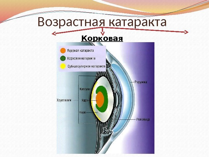 Возрастная катаракта Корковая Ядерная *Субкапсулярная  