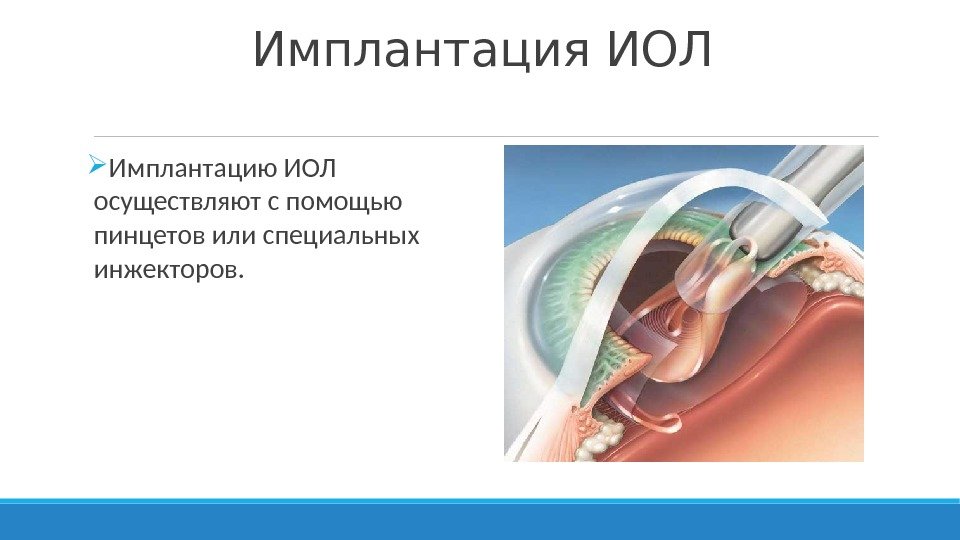 Имплантация ИОЛ Имплантацию ИОЛ осуществляют с помощью пинцетов или специальных инжекторов. 