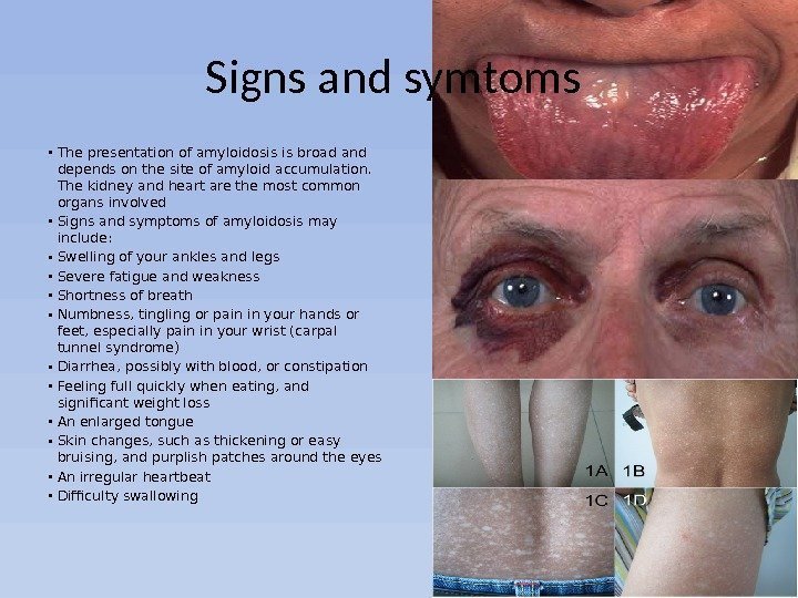 Signs and symtoms  • The presentation of amyloidosis is broad and depends on