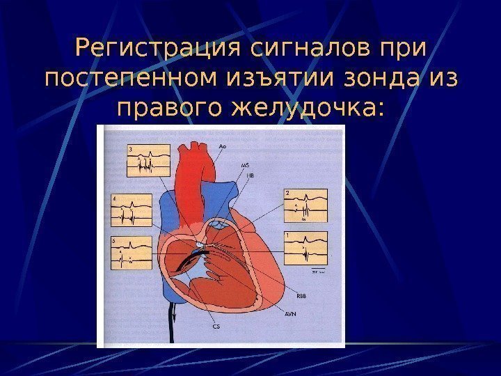   Регистрация сигналов при постепенном изъятии зонда из правого желудочка:  