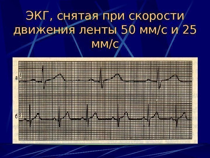   ЭКГ, снятая при скорости движения ленты 50 мм/с и 25 мм/с 