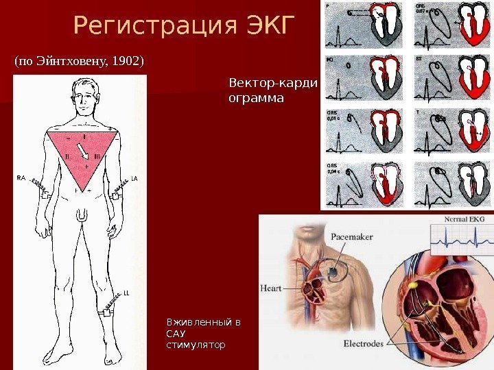 (по Эйнтховену, 1902) Регистрация ЭКГ Вживленный в САУ стимулятор Вектор-карди ограмма 