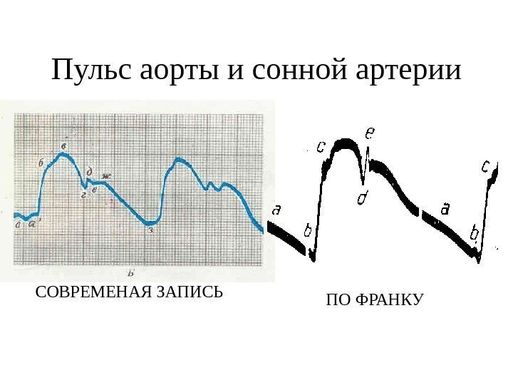   Пульс аорты и сонной артерии СОВРЕМЕНАЯ ЗАПИСЬ ПО ФРАНКУ 