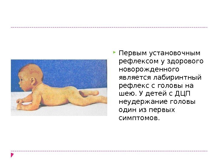  Первым установочным рефлексом у здо рового новорожденного является лабиринтный рефлекс с го ловы