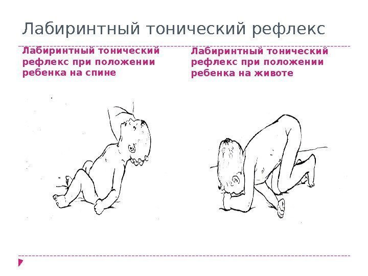 Лабиринтный тонический рефлекс при положении ребенка на спине Лабиринтный тонический рефлекс при положении ребенка