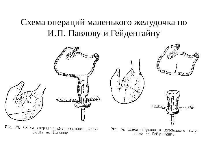   Схема операций маленького желудочка по И. П. Павлову и Гейденгайну 