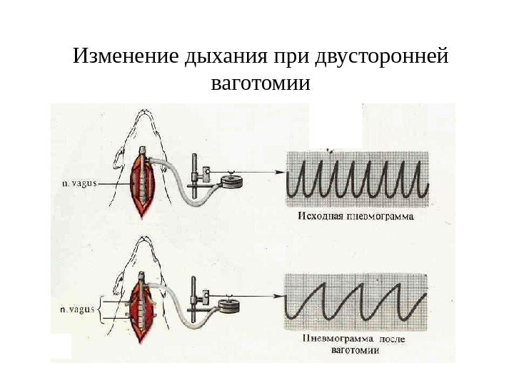   Изменение дыхания при двусторонней ваготомии 