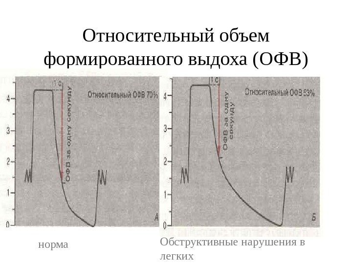   Относительный объем формированного выдоха (ОФВ) норма Обструктивные нарушения в легких 