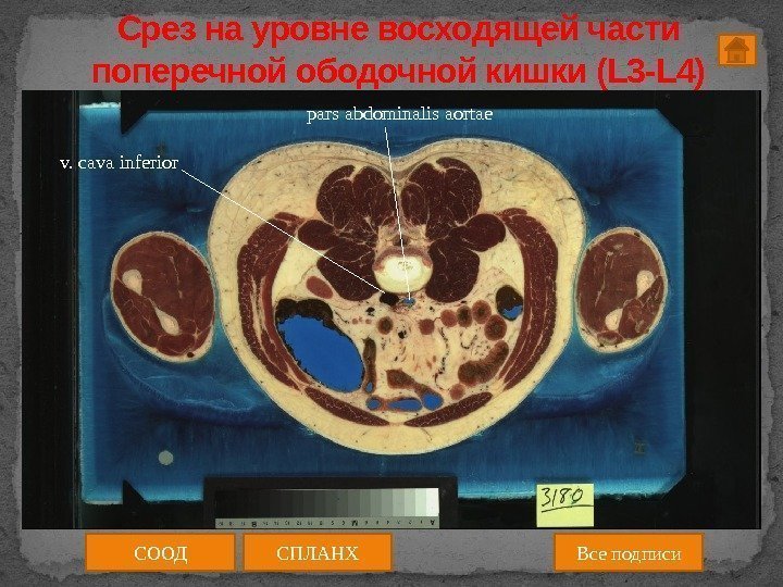 Срез на уровне восходящей части поперечной ободочной кишки (L 3 -L 4) pars abdominalis