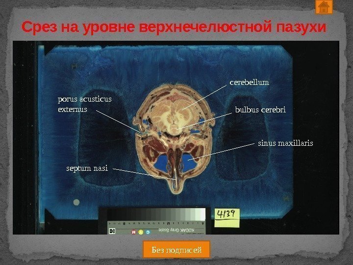 Срез на уровне верхнечелюстной пазухи cerebellum bulbus cerebri sinus maxillaris septum nasiporus acusticus externus