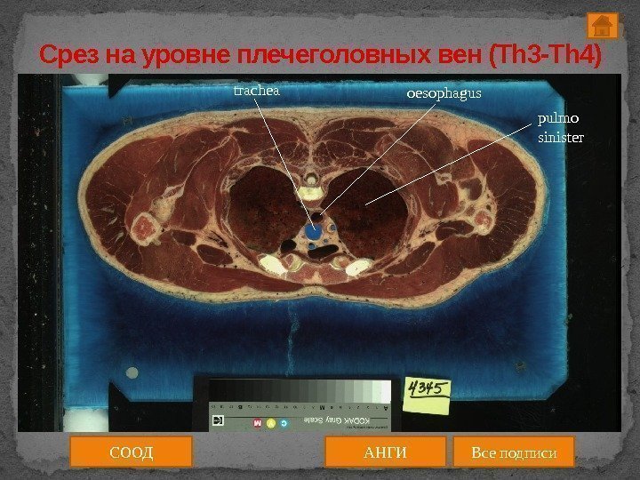 pulmo sinistertrachea oesophagus СООД АНГИ Все подписи. Срез на уровне плечеголовных вен (Th 3