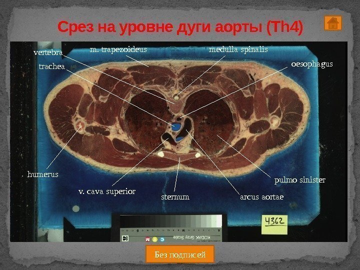 Срез на уровне дуги аорты (Th 4) oesophagus trachea pulmo sinister arcus aortaev. cava