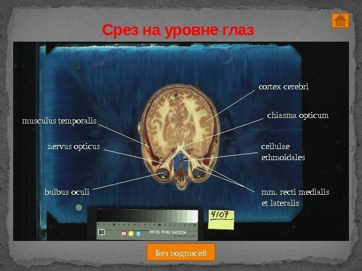 Срез на уровне глаз chiasma opticum nervus opticus cortex cerebri cellulae ethmoidalesmusculus temporalis mm.