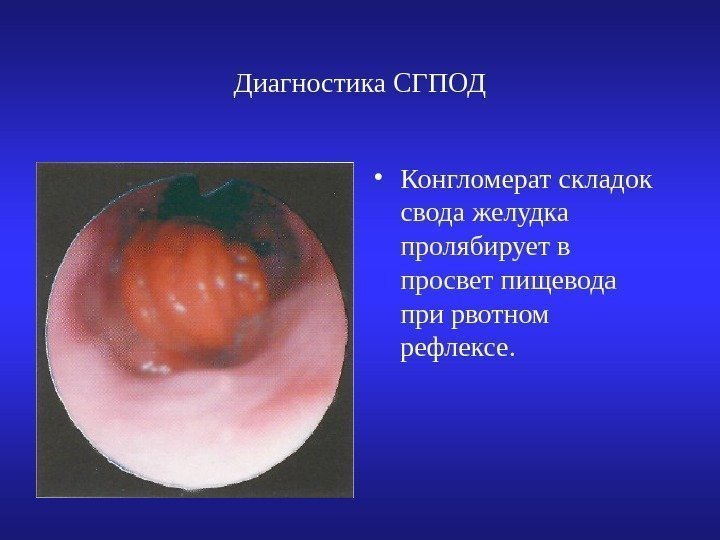 Диагностика СГПОД • Конгломерат складок свода желудка пролябирует в просвет пищевода при рвотном рефлексе.