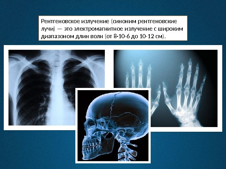 Рентгеновское излучение (синоним рентгеновские лучи) — это электромагнитное излучение с широким диапазоном длин волн