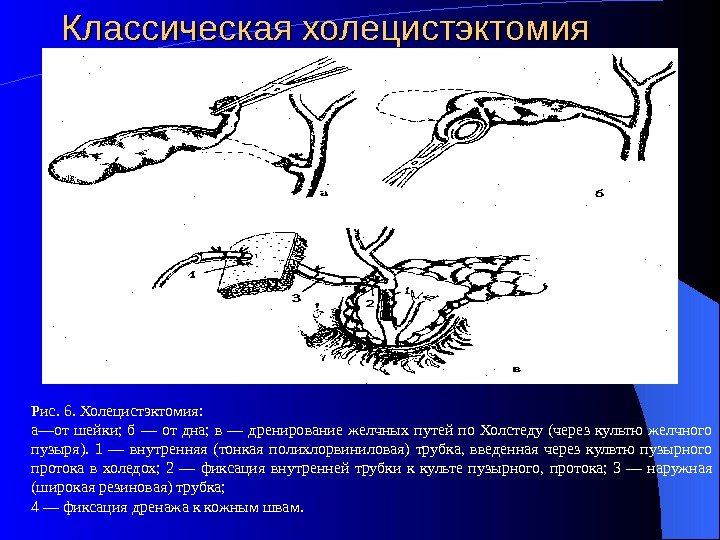 Классическая холецистэктомия Рис. 6. Холецистэктомия: а—от шейки;  б — от дна;  в