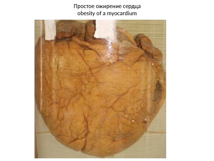 Простое ожирение сердца obesity of a myocardium 