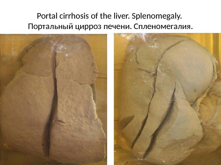 Portal cirrhosis of the liver. Splenomegaly.  Портальный цирроз печени. Спленомегалия. 
