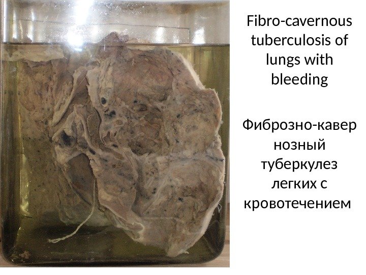 Fibro-cavernous tuberculosis of lungs with bleeding Фиброзно-кавер нозный туберкулез легких с кровотечением 