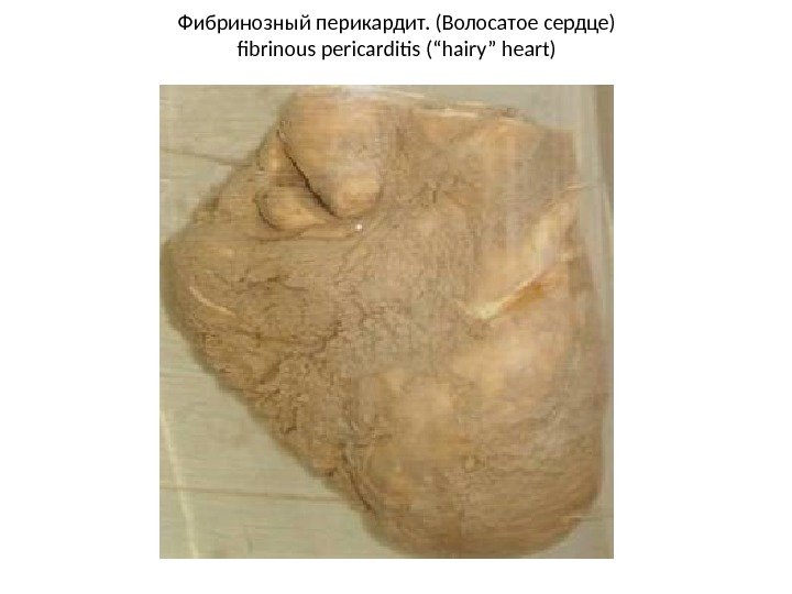 Фибринозный перикардит. (Волосатое сердце) fibrinous pericarditis (“hairy” heart) 