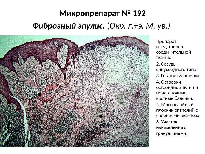Микропрепарат № 192 Фиброзный эпулис.  ( Окр. г. +э. М. ув. ) 