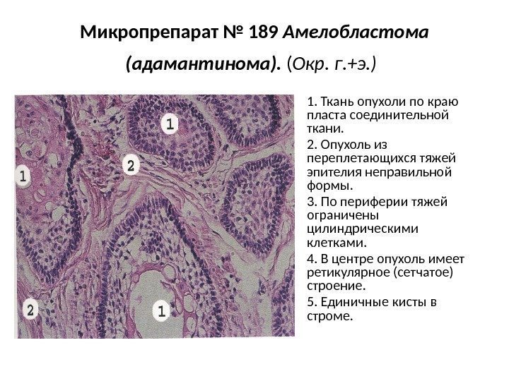 Микропрепарат № 189 Амелобластома (адамантинома).  ( Окр. г. +э. )  • 1.