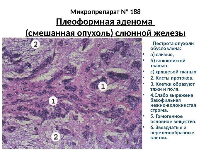 Микропрепарат № 188 Плеоформная аденома (смешанная опухоль) слюнной железы • .  Пестрота опухоли