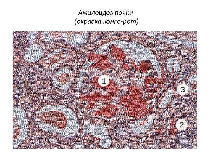 Амилоидоз почки (окраска конго-рот) 