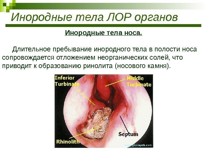 Инородные тела ЛОР органов Инородные тела носа. Длительное пребывание инородного тела в полости носа