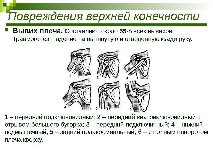  Вывих плеча.  Составляют около 55 всех вывихов.  Травмогенез: падение на вытянутую