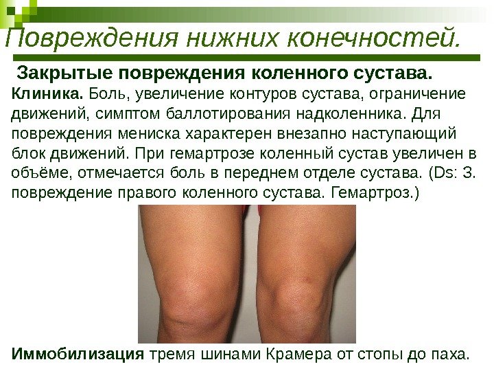  Закрытые повреждения коленного сустава.  Клиника.  Боль, увеличение контуров сустава, ограничение движений,