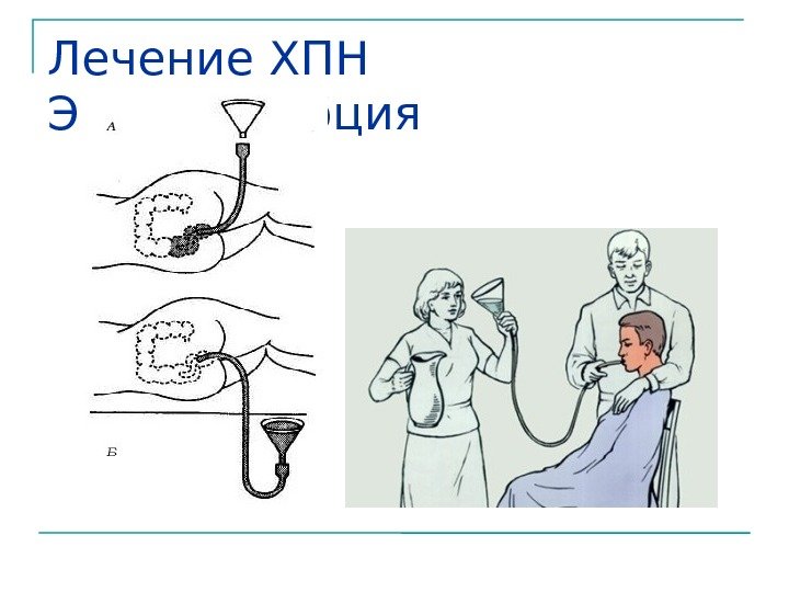 Лечение ХПН Энтеросорбция 