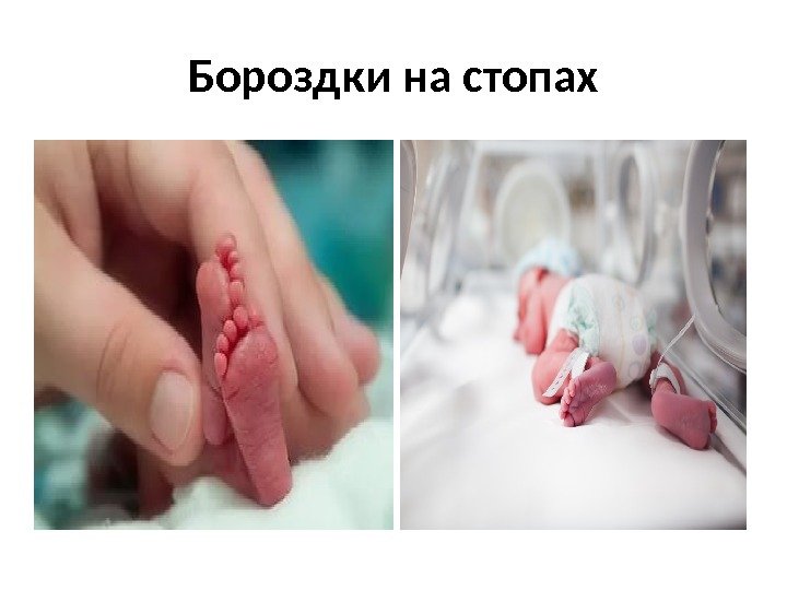 Бороздки на стопах 