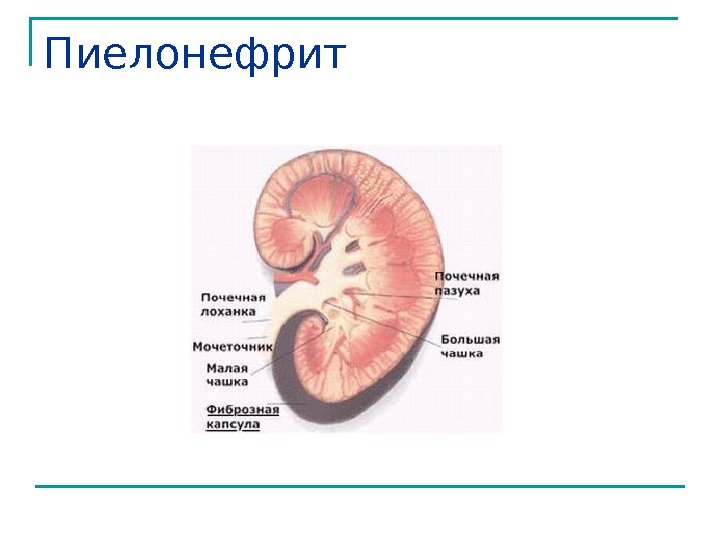 Пиелонефрит 