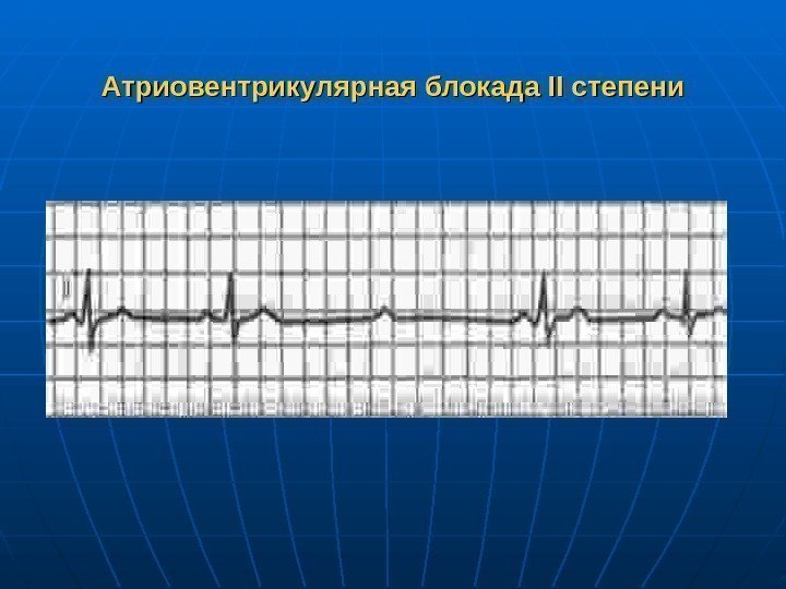 Атриовентрикулярная блокада II степени 