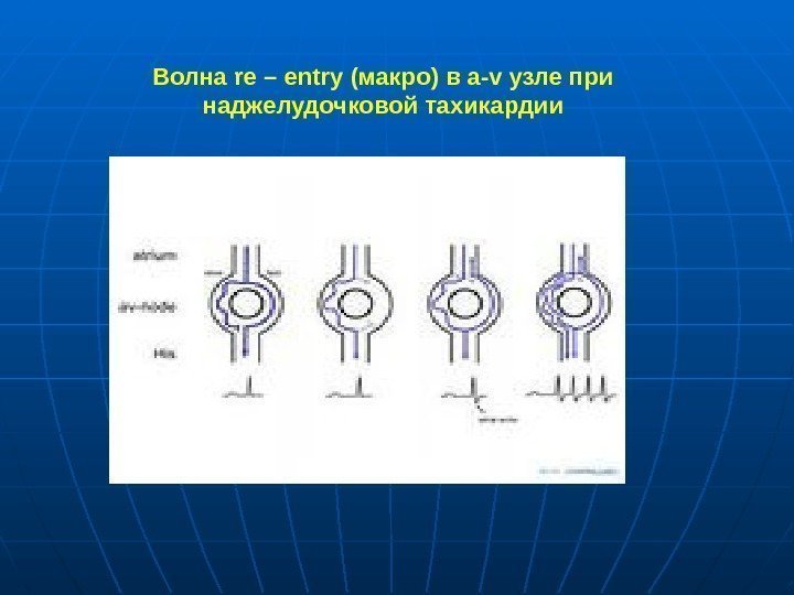 Волна re – entry (макро) в a-v узле при наджелудочковой тахикардии 