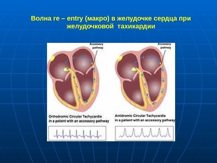 Волна re – entry (макро) в желудочке сердца при желудочковой тахикардии 