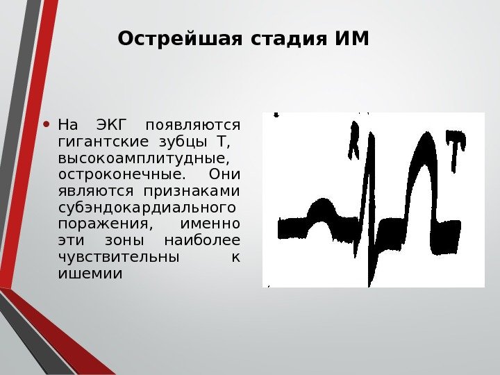 Острейшая стадия ИМ • На ЭКГ появляются гигантские зубцы Т, высокоамплитудные,  остроконечные. 