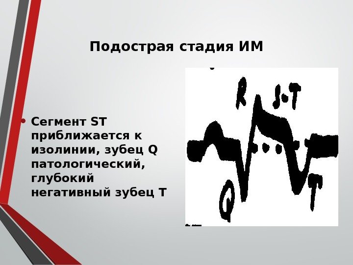 Подострая стадия ИМ • Сегмент ST приближается к изолинии, зубец Q патологический,  глубокий