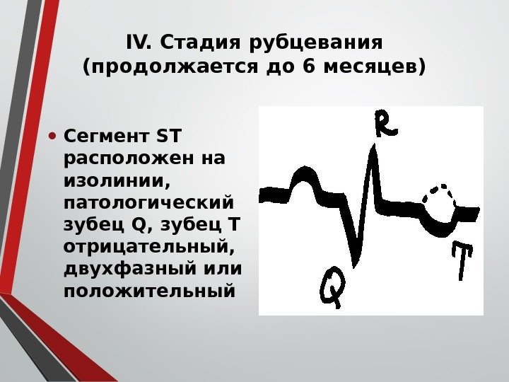 ІV. Стадия рубцевания (продолжается до 6 месяцев) • Сегмент ST расположен на изолинии, 