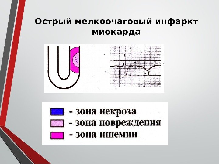 Острый мелкоочаговый инфаркт миокарда 