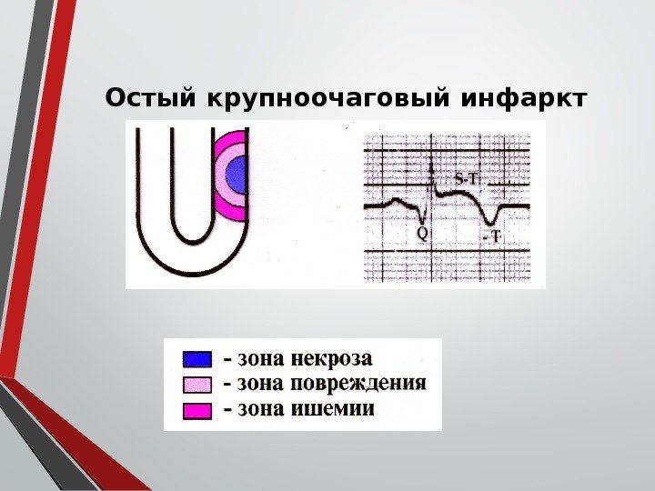 Остый крупноочаговый инфаркт миокарда 