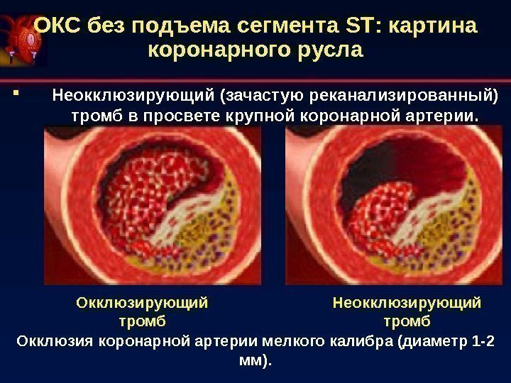 ОКС без подъема сегмента ST : картина коронарного русла Неокклюзирующий (зачастую реканализированный) тромб в